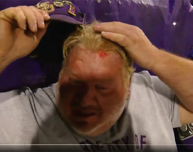 LSU baseball fan Cory showing his home run ball injury